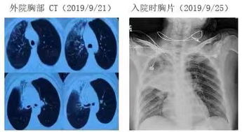 河南多地出现肺炎感染，最新情况如何？